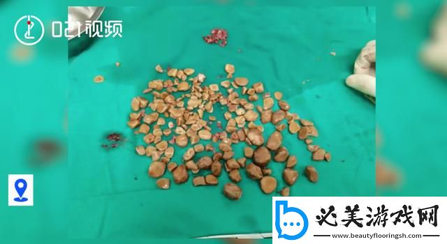 “体内结石”摇身一变